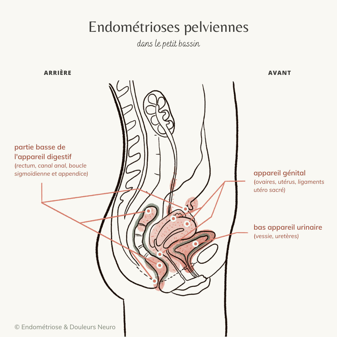 endometrioseneuro.com/wp-content/uploads/2023/08/E...